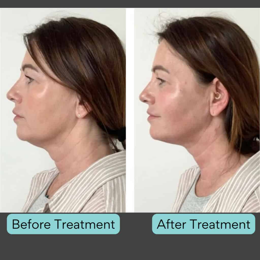 Endolift before and after results