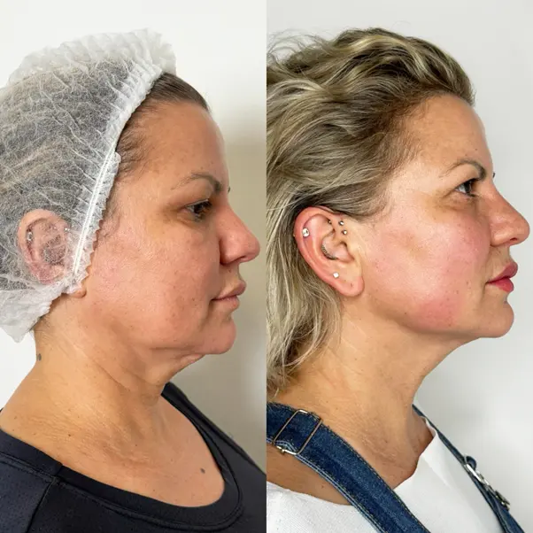 Endolift laser treatment procedure